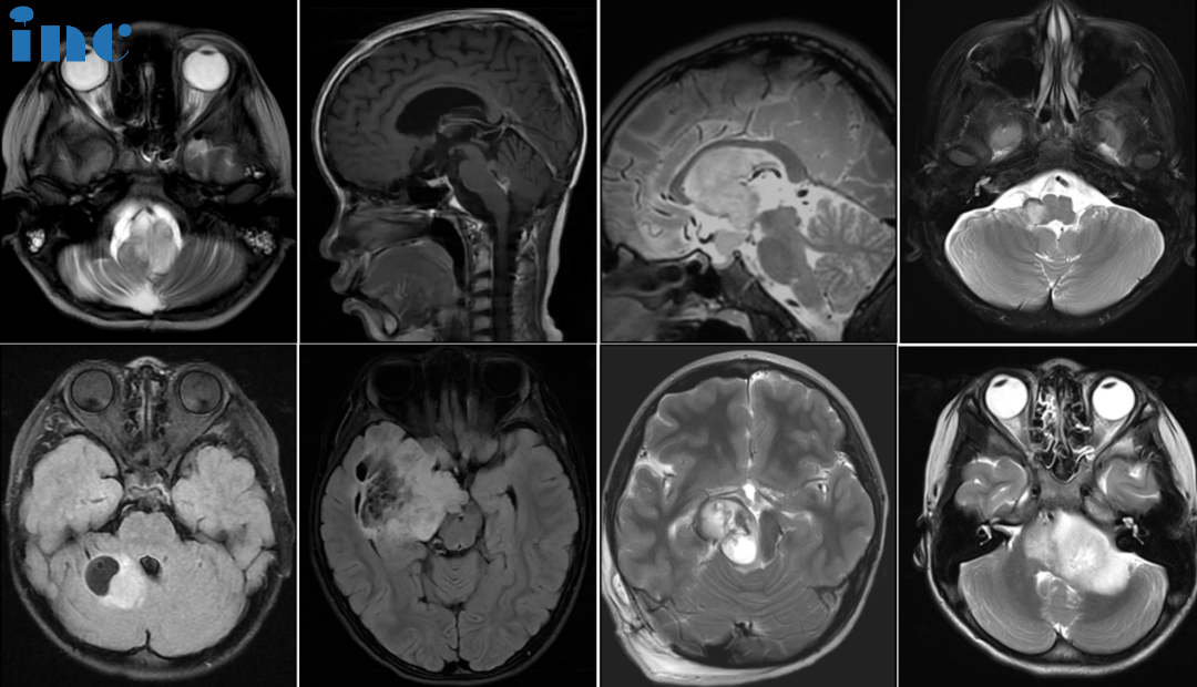 今年，截至目前巴教授指导手术的8个病例的术前磁共振资料，肿瘤位于脑干、脑室、桥臂、颞叶、小脑等疑难位置。