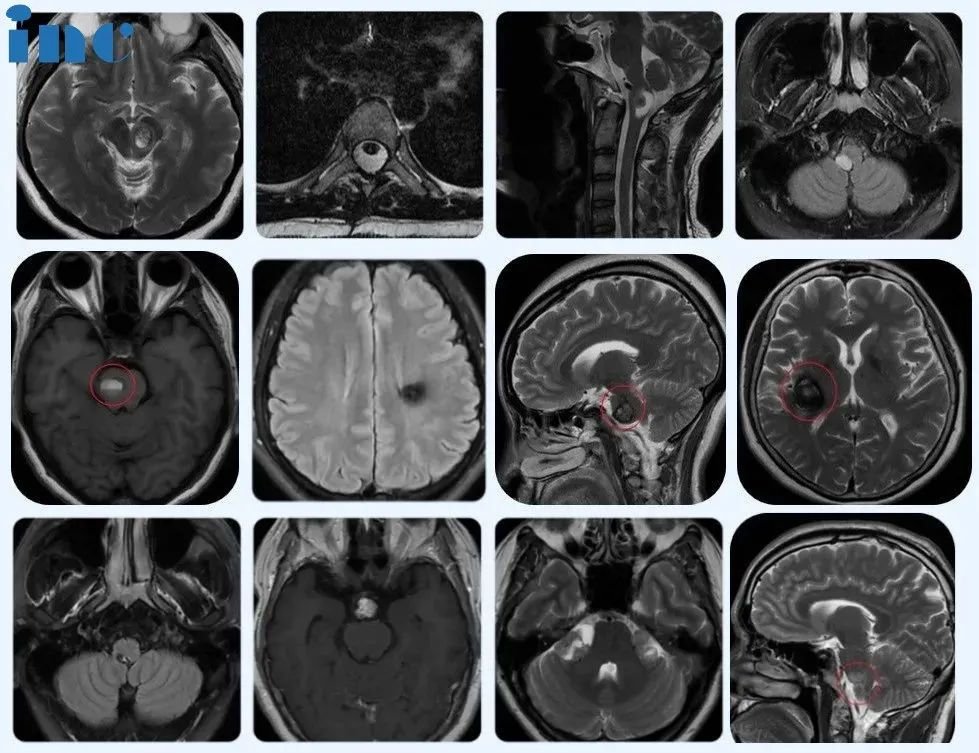 部分苏州独墅湖医院巴教授成人示范教学手术患者术前影像，接受手术的多名患者肿瘤分别位于脑干、脊髓及丘脑、基底节、桥臂、松果体、鞍区、功能区、CPA桥小脑脚区等疑难位置。