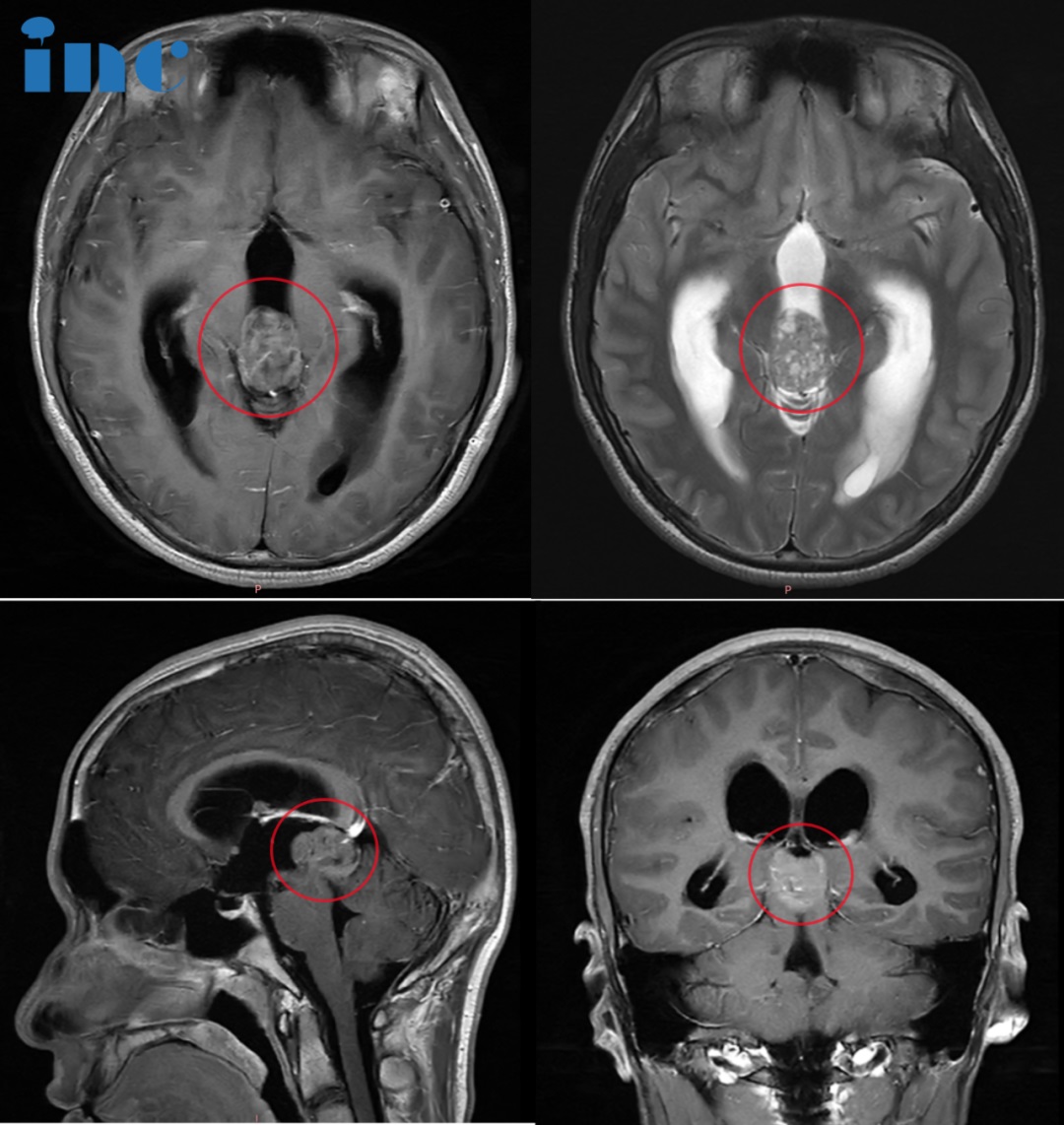 16岁少年——松果体占位性病变