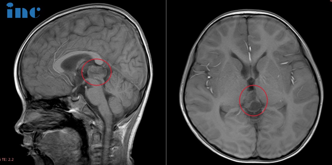 6岁男孩——松果体占位性病变