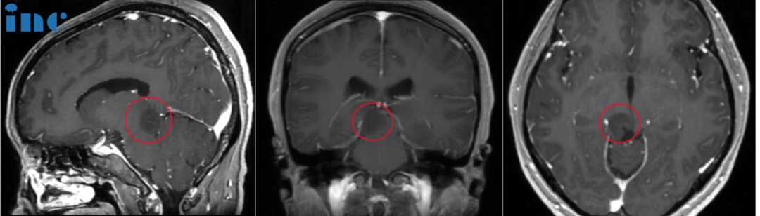 30多岁女性——脑干胶质瘤