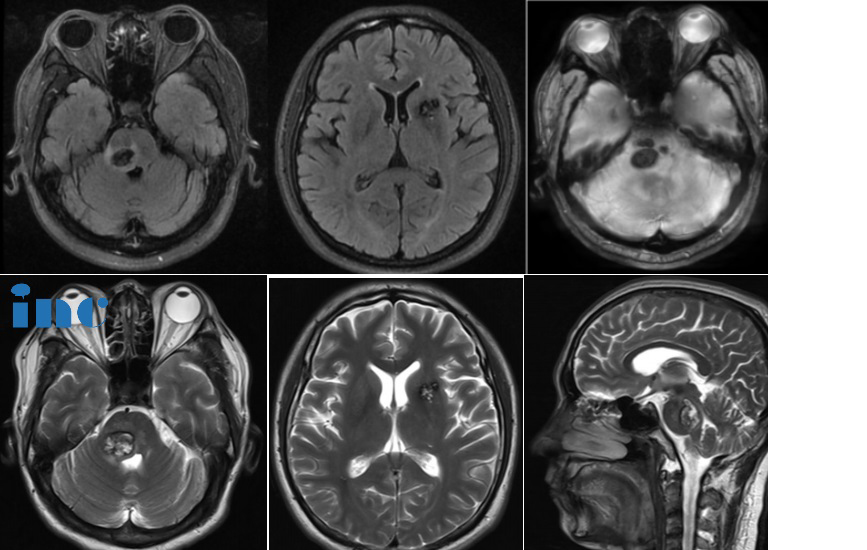 43岁男性——多发海绵状血管瘤合并脑干出血