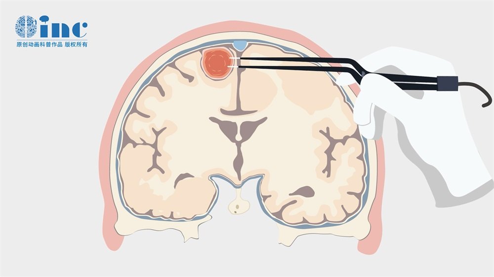 知识分享：脑膜海绵状血管瘤是什么？