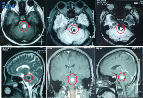 43岁女士--脑干海绵状血管瘤合并出血
