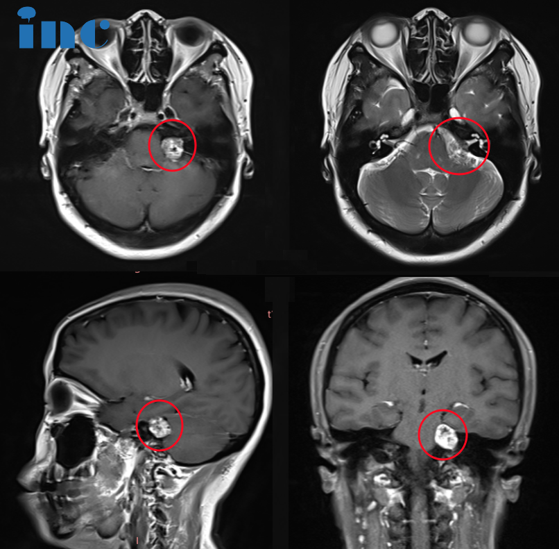 46岁女士-左侧听神经瘤