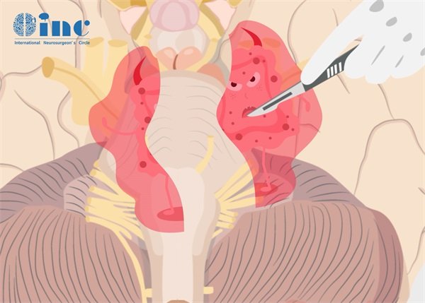 颅内海绵状血管瘤切除手术和后遗症