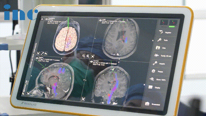 术中神经导航显示出的肿瘤及周围的神经纤维