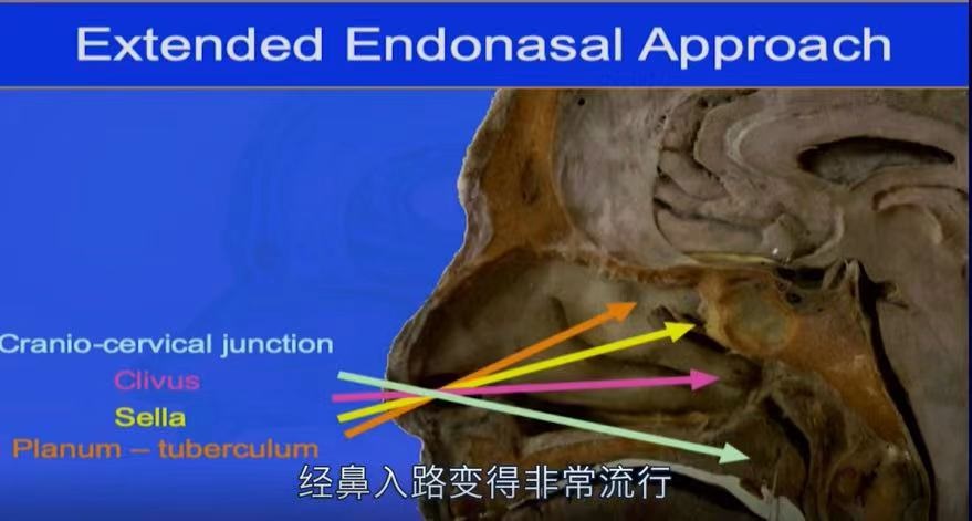 Froelich教授演讲截图：经鼻内镜示意图