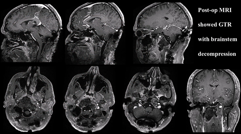 术后MRI显示肿瘤完全切除，且脑干解压