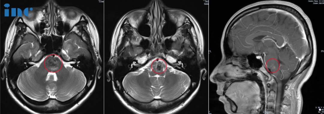 28岁女性-脑干（桥-延交界处）海绵状血管瘤