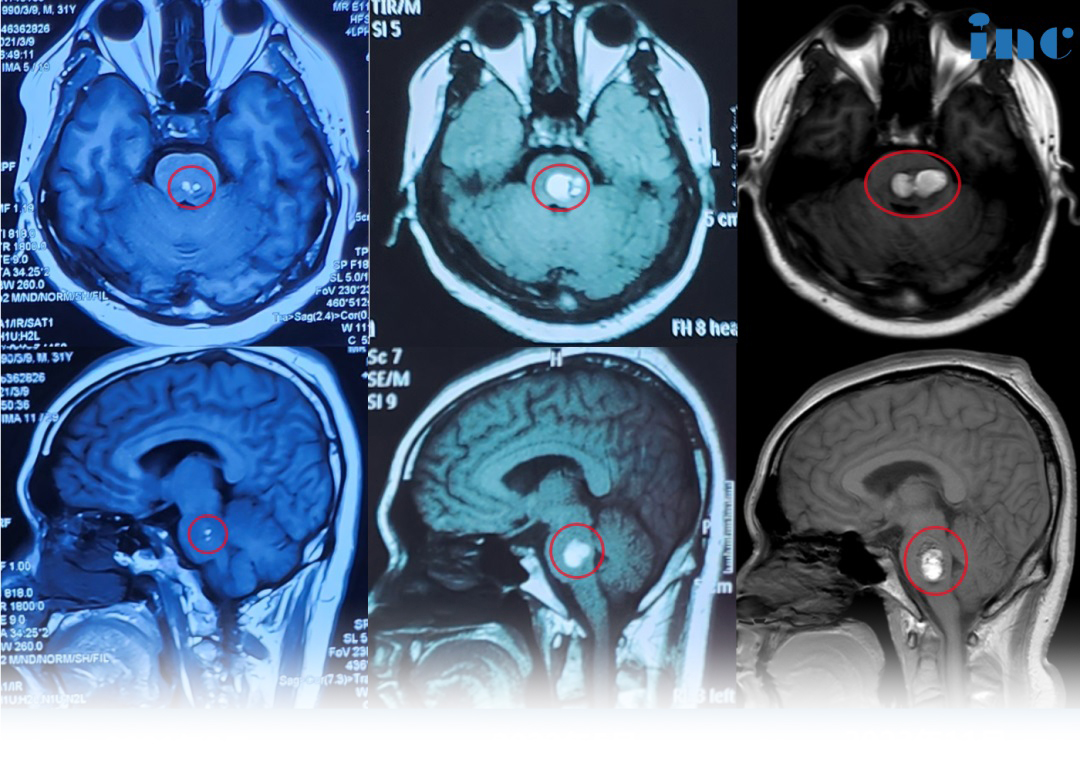 风险大、手术难、预后不明？INC神外大咖远程咨询，为疑难脑瘤患者重