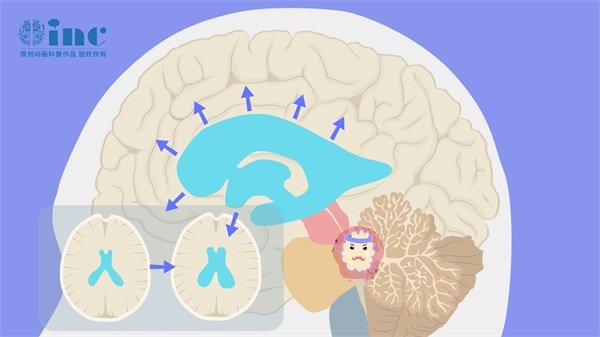 脊髓胶质瘤疼痛有什么好办法？5种方式可缓解！