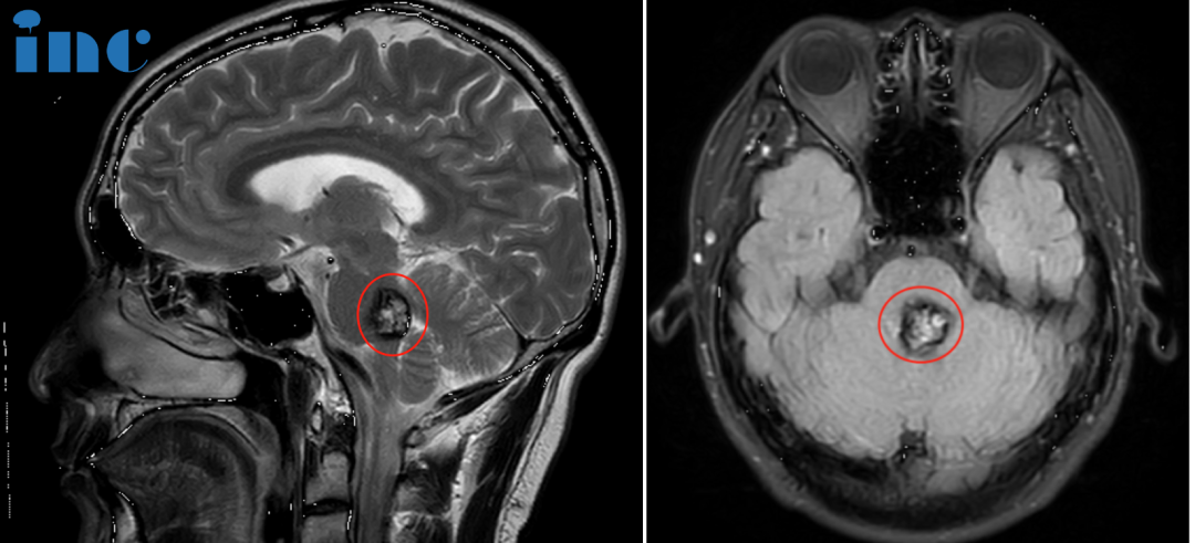 脑干海绵状血管瘤术前MRI