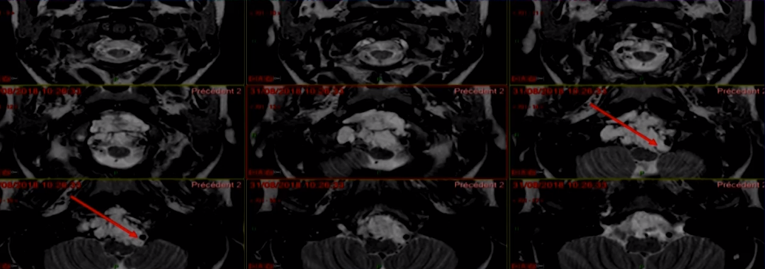 双镜联合全切颅颈交界区脊索瘤——术前MRI图