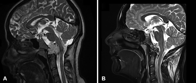 双镜联合全切颅颈交界区脊索瘤——术前术后MRI