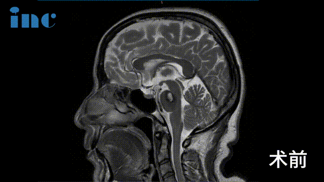 脑干海绵状血管瘤影像