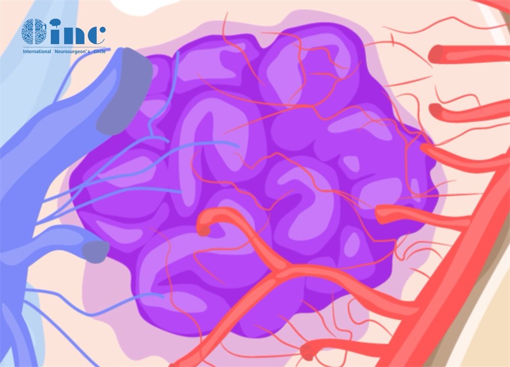血管型脑膜瘤怎么预防复发？注意这7个方面！