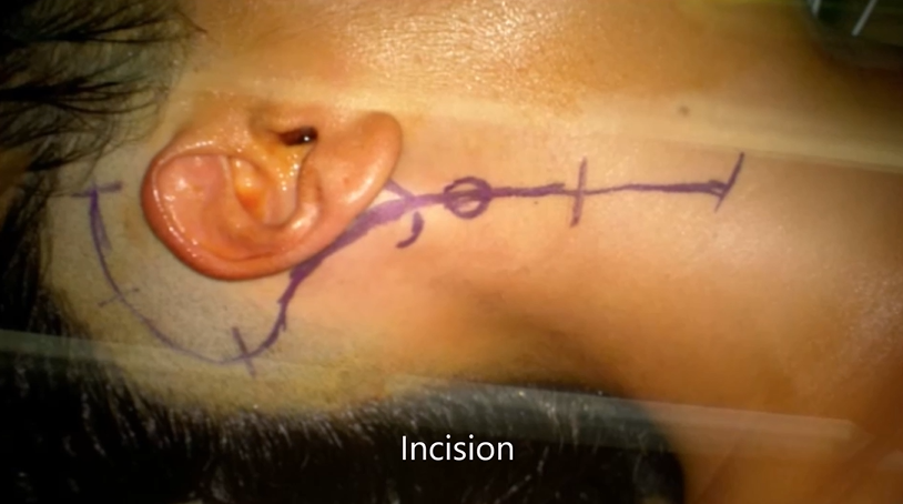 21岁女性颅颈交界处脊索瘤安全全切——手术切口