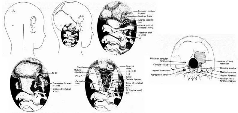 图：Bertalanffy和其导师Seeger（1991）提出的“dorsolateral,suboccipital,transcondylar approach”入路