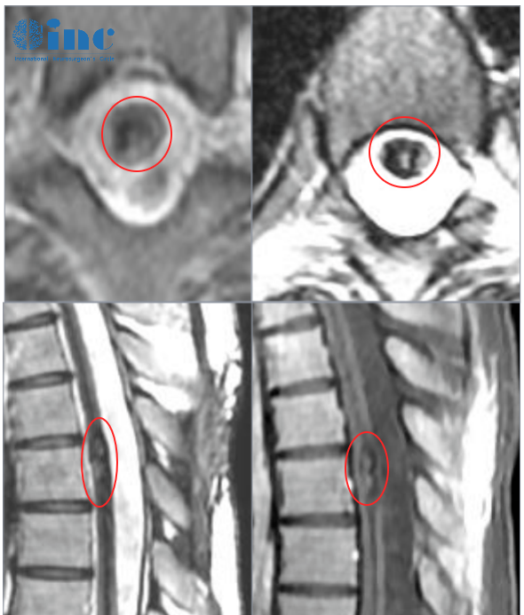 脊髓肿瘤手术——MRI