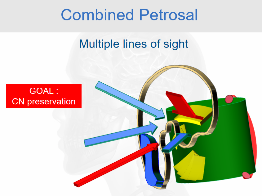 联合岩骨入路：多条视线，目标是保护颅神经