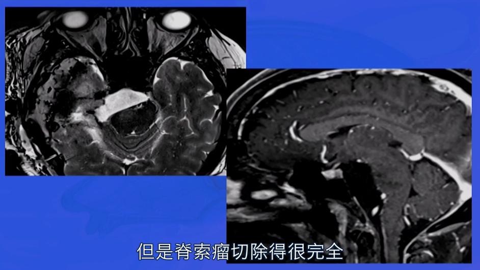 脊索瘤患者影像