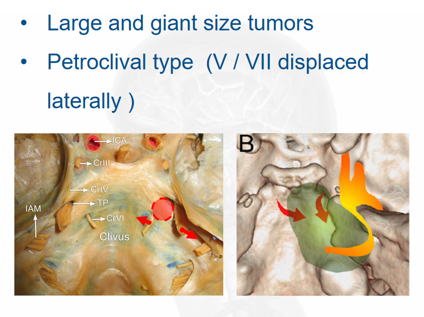 适应症：巨大肿瘤；岩斜肿瘤类型(V/VII侧向位移)