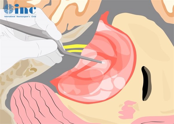 听神经瘤手术从哪开刀好