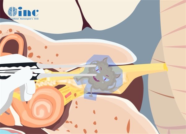听神经瘤手术听力消失但依旧耳鸣