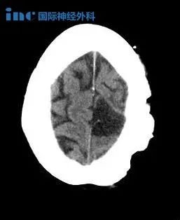 巨大脑膜瘤长在大脑镰旁、大静脉窦“零后遗症”全切，术后5年无复发