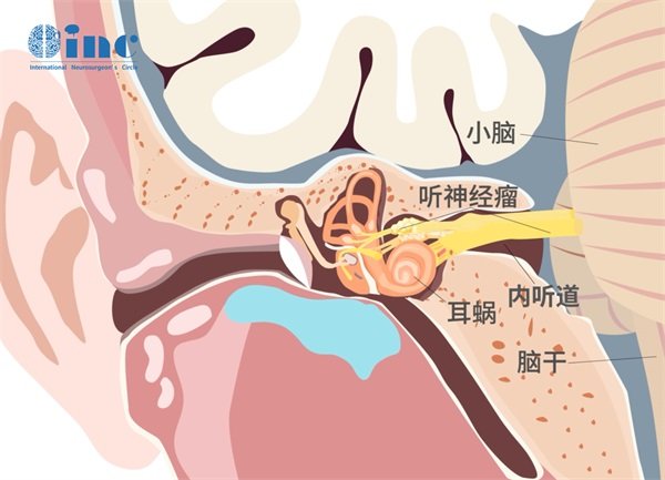 听神经瘤手术入路区别和手术路径的选择