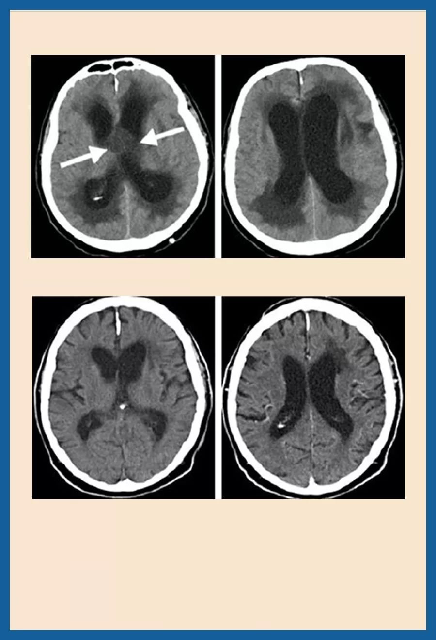 颅咽管瘤治疗案例