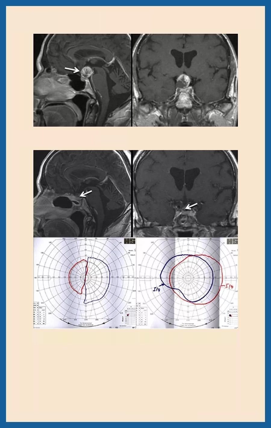 颅咽管瘤治疗案例