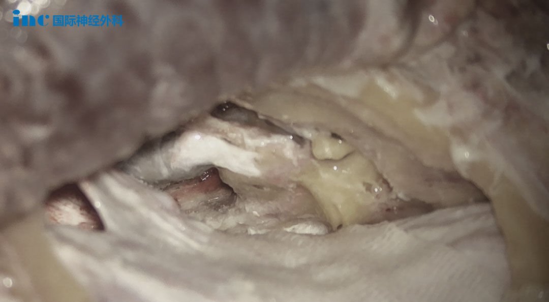 福教授较大限度磨除Kawase三角