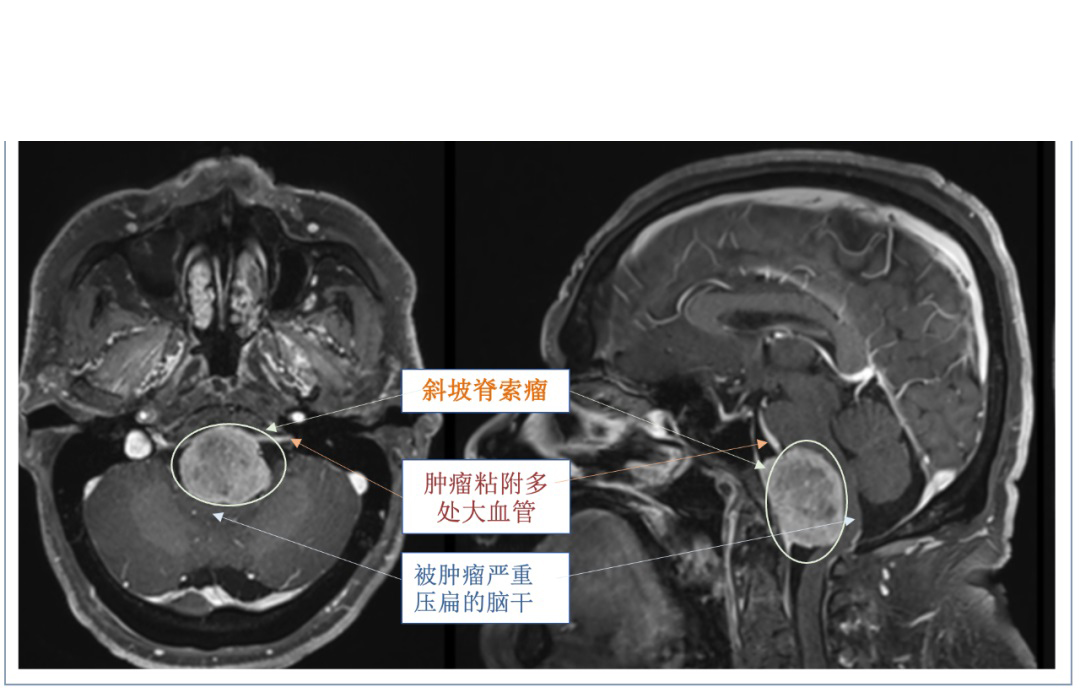 单鼻孔内镜下全切斜坡脊索瘤