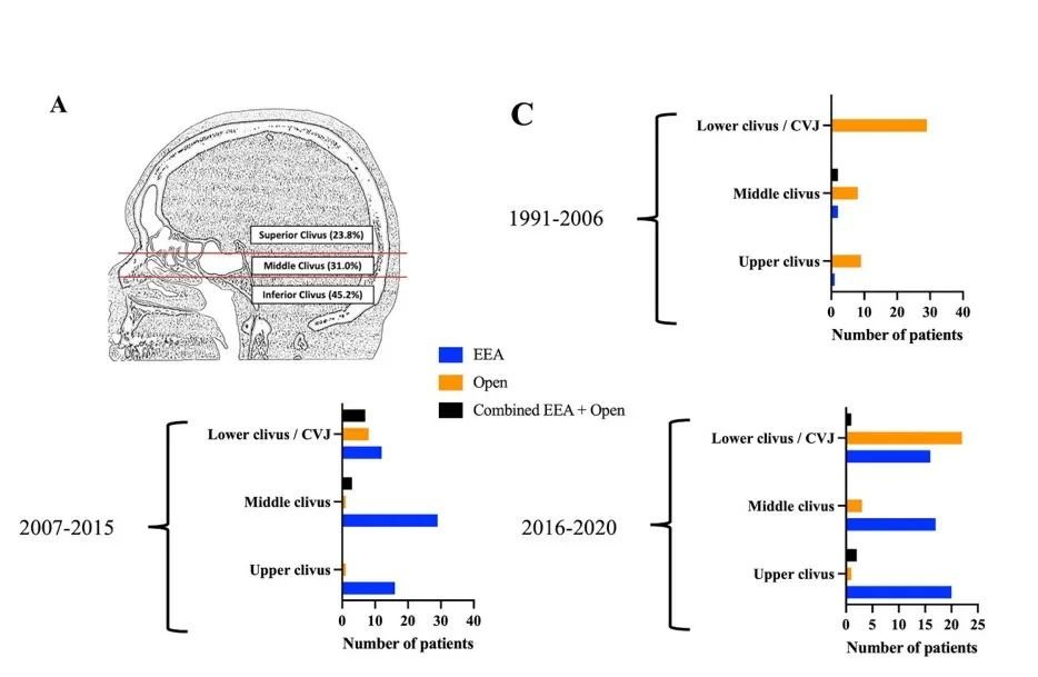 单鼻孔内镜下全切斜坡脊索瘤——手术入路