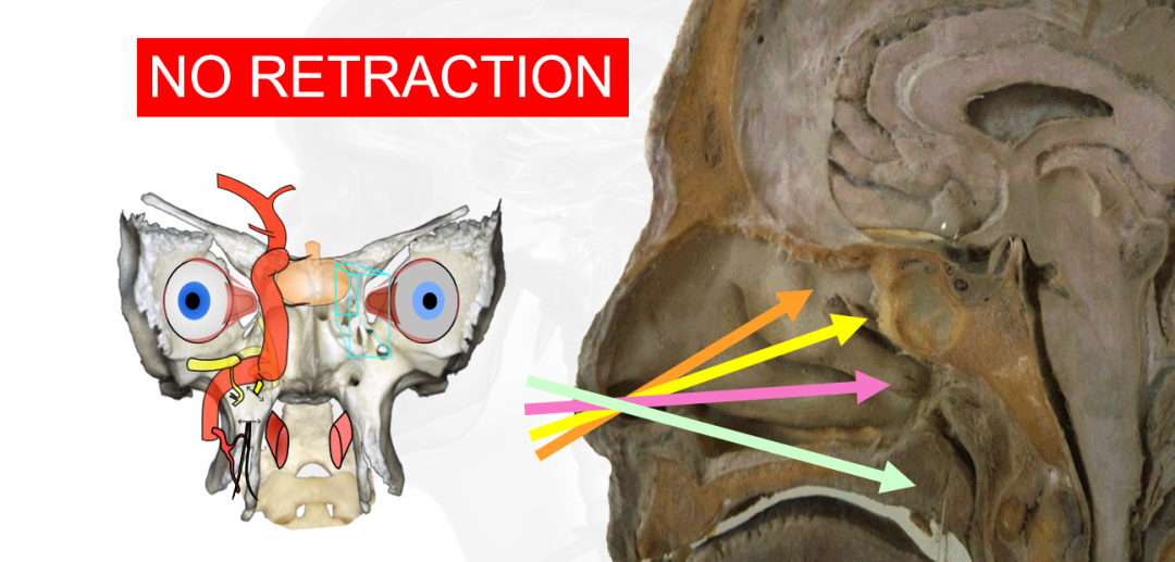 单鼻孔经鼻内镜手术操作示意图图片