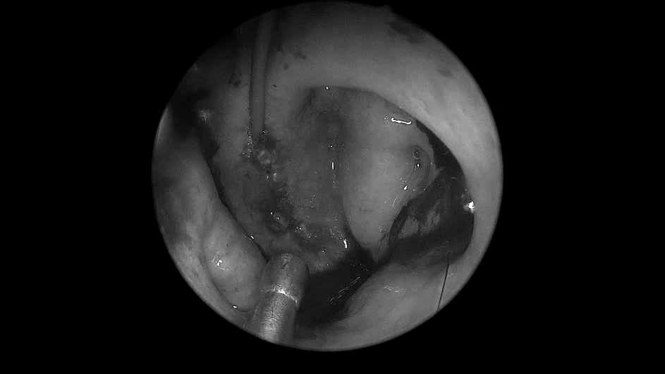 单鼻孔进入，粘膜切开