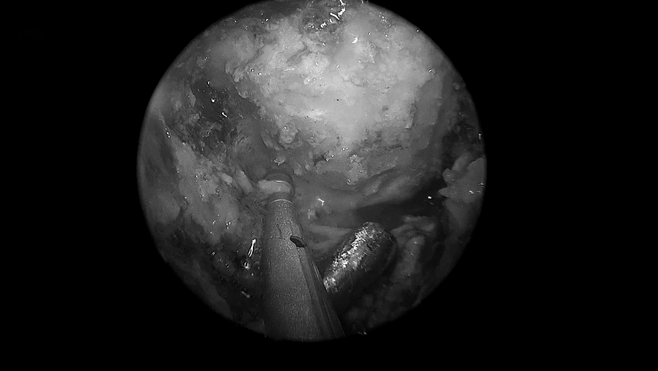 单鼻孔进入，粘膜切开