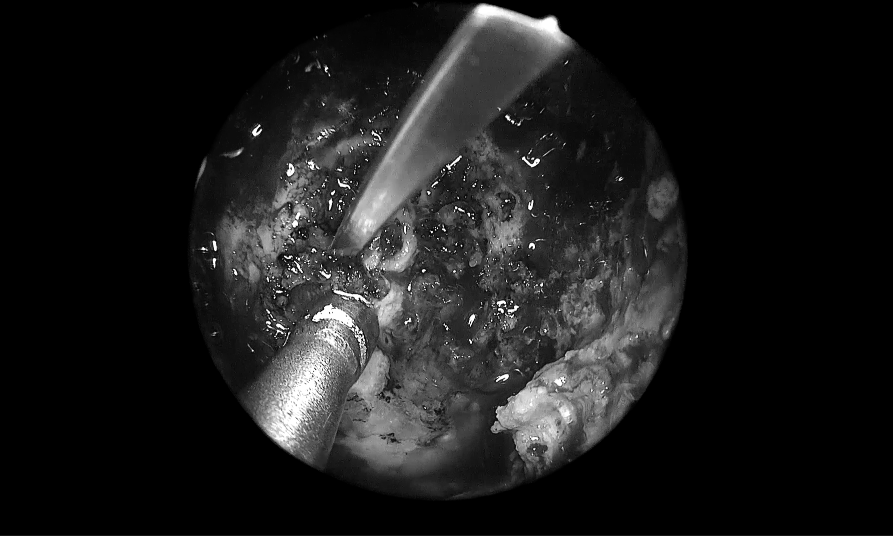 单鼻孔进入，粘膜切开