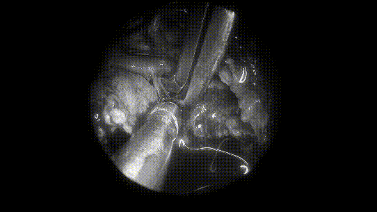 取出部分肿瘤，进行瘤内减压