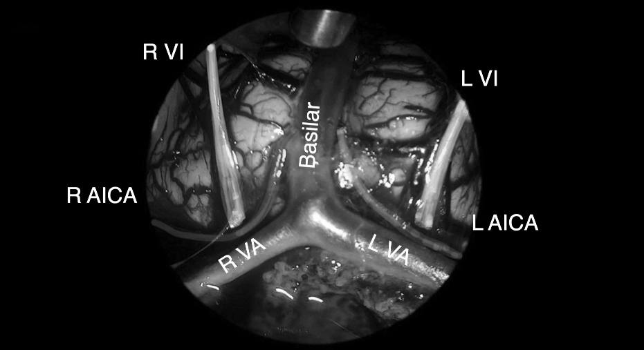 肿瘤取出后，可见清晰的周围血管神经。R VI，右侧展神经;LVI，左侧展神经;R AICA，右侧小脑下前动脉;L AICA，左小脑下前动脉;R VA，右侧椎动脉;LVA，左侧椎动脉;Basilar ，基底vVI，展神经;VII，面神经;VIII，前庭蜗神经;R AICA，右侧小脑下前动脉;