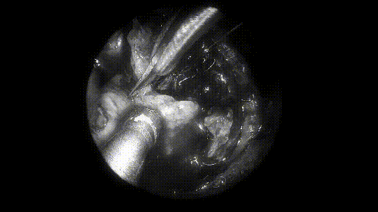 取出部分肿瘤，进行瘤内减压