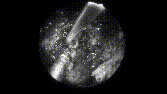 取出部分肿瘤，进行瘤内减压