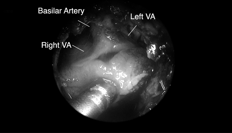 将肿瘤分离出来——Basilar Artery，基底动脉;Left VA，左侧椎动脉; Right VA，右侧椎动脉;
