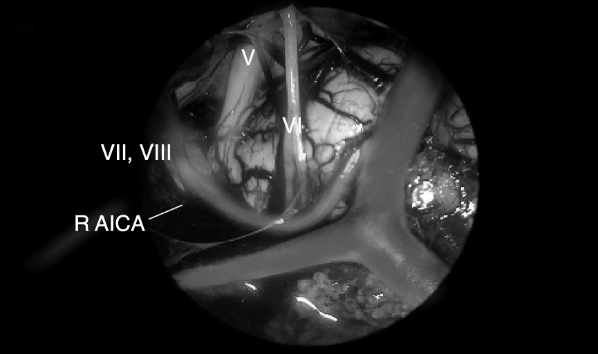 VI，展神经;VII，面神经;VIII，前庭蜗神经;R AICA，右侧小脑下前动脉;