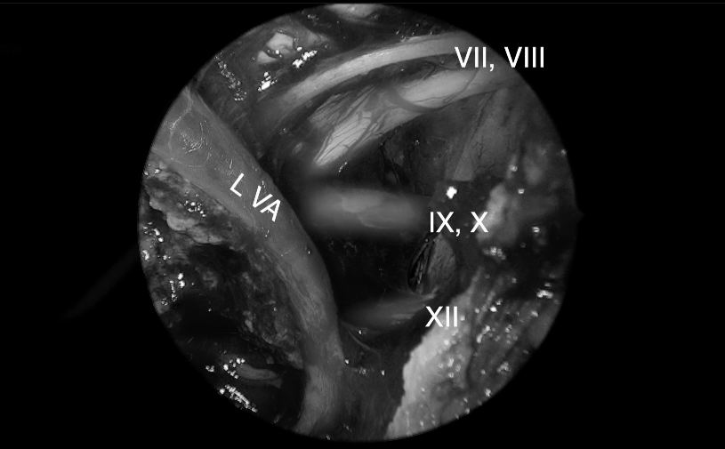 可见周围神经完好。VlI，面神经;VIII，前庭蜗神经;L VA，左侧椎动脉;IX，舌咽神经;X，迷走神经;XII，舌下神经