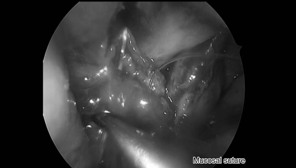 鼻腔内粘膜缝合