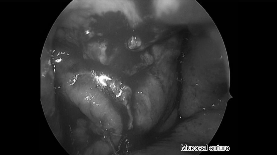 鼻腔内粘膜缝合
