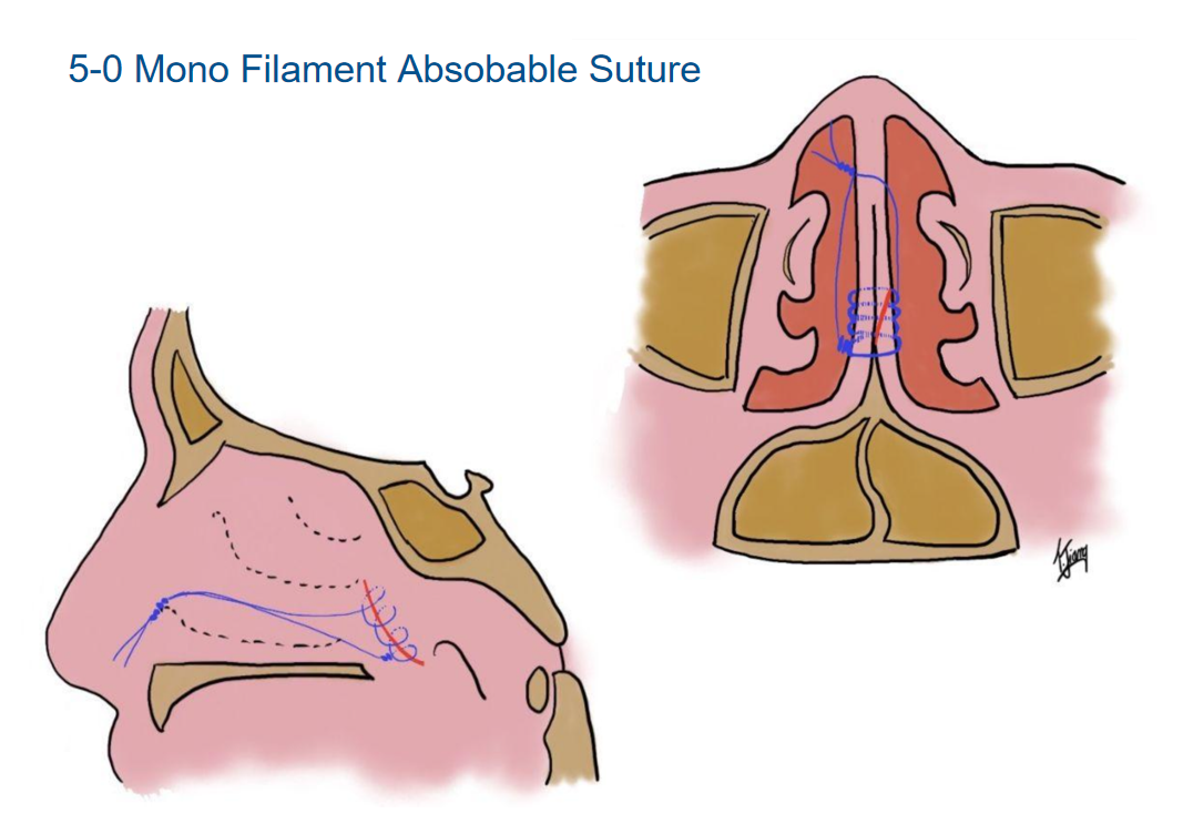 鼻腔内缝合示意图